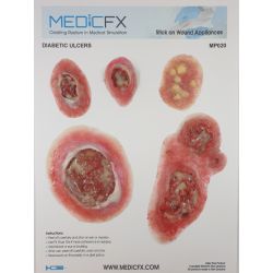 Sheet Diabetic ulcers